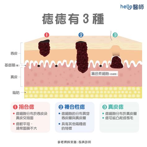 痣 生成原因|痣形成的原因？痣長毛、痣變多變大是痣病變？5招判。